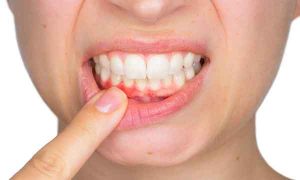 جایگزین عمل پیوند لثه