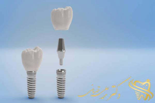 تفاوت لمینت دندان و ایمپلنت دندان چیست؟