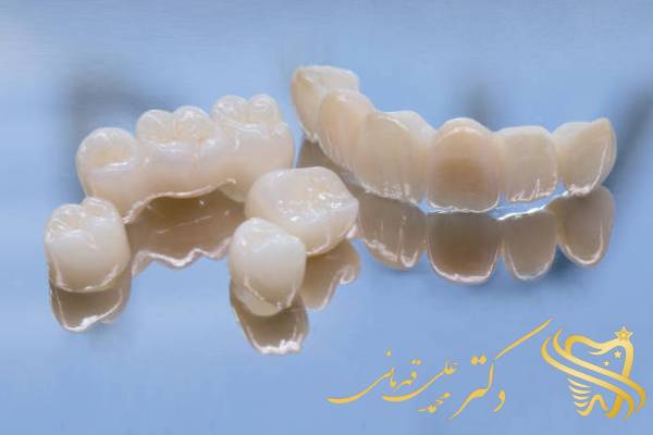 تفاوت لمینت دندان و ایمپلنت دندان چیست؟