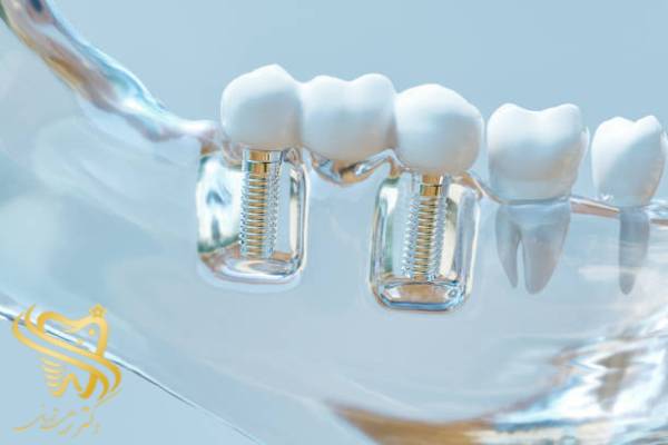 چه مدت بعد از کشیدن دندان باید ایمپلنت کرد؟