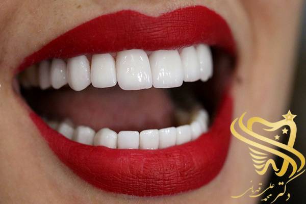 آیا کامپوزیت باعث پوسیدگی دندان می‌شود؟