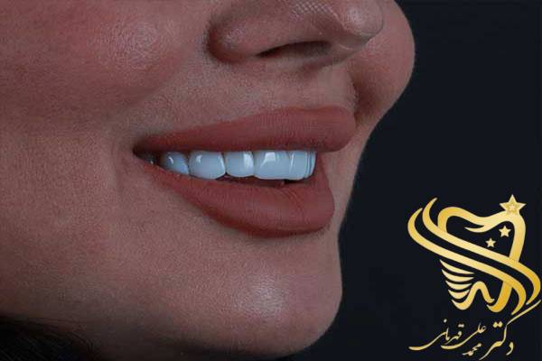 تفاوت و یا فرق لمینت و کامپوزیت چیست؟