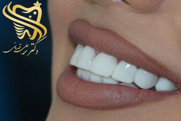 عکس لمینت و کامپوزیت دندان