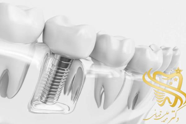مراقیت های بعد از ایمپلنت دندان