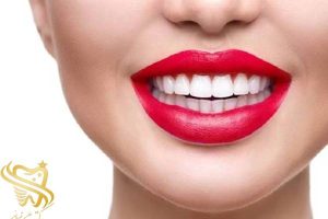 مراقبت های بعد از لمینت دندان