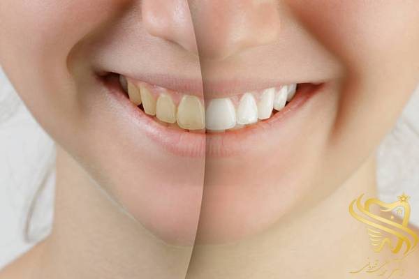 بلیچینگ دندان چه مدت ماندگاری دارد؟