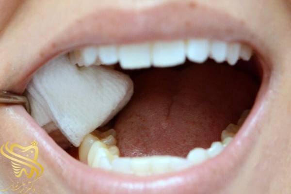 خونریزی بعد از کشیدن دندان عقل