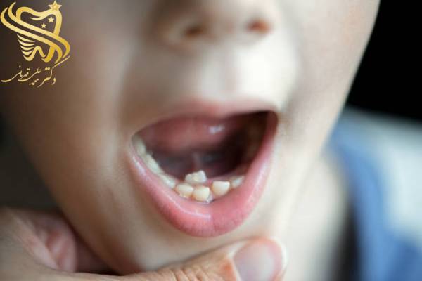 عکس دندان کج کودکان