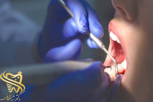 پرکردن دندان بدون عصب کشی