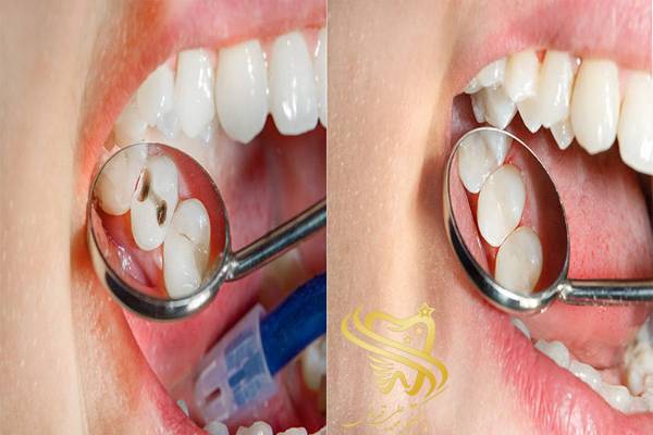 پرکردن دندان بدون عصب کشی
