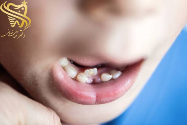 کج شدن دندان کودکان