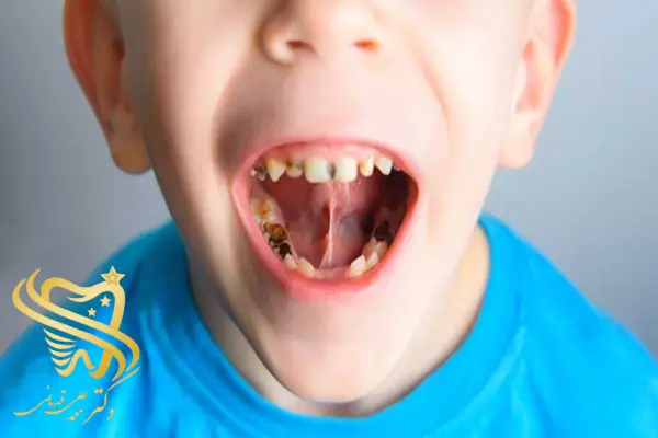 آبسه دندان کودکان