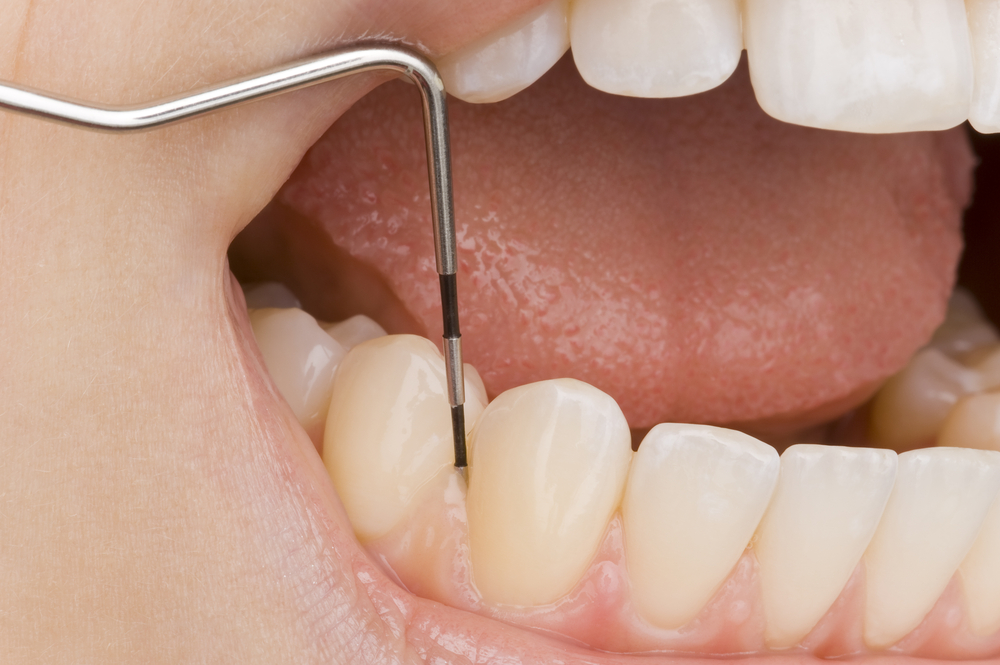 مراقبت های بعد از جرمگیری دندان
