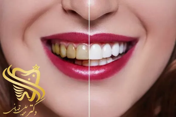 مدت زمان لازم برای برداشتن کامپوزیت دندان