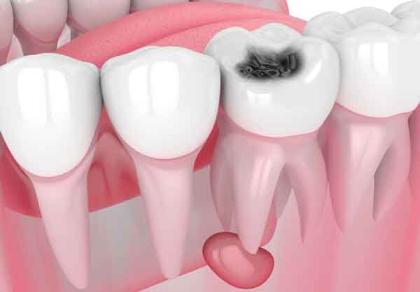 علائم سرطان دندان و لثه