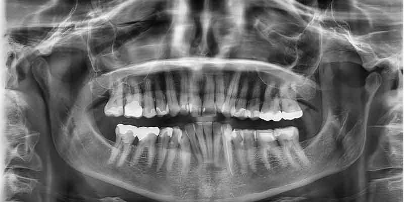 تشخیص پوسیدگی دندان از روی عکس opg
