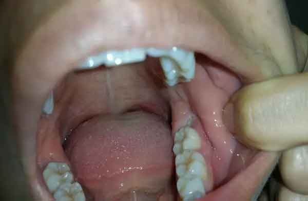 سرطان دندان عقل چیست؟