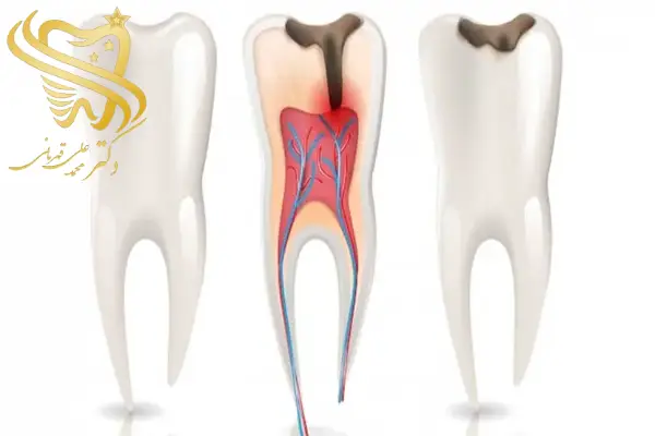 عفونت ریشه دندان عصب کشی