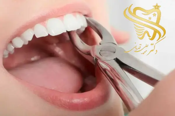 چند روز بعد از کشیدن دندان میتوان دندان مصنوعی گذاشت؟