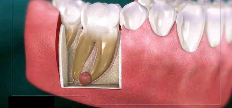 سرطان ریشه دندان، علائم و روش های درمان