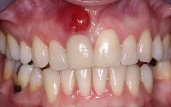آیا عفونت دندان به سر می زند؟