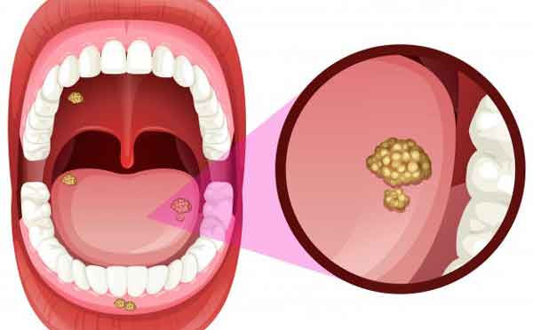 اشکال مختلف سرطان دهان
