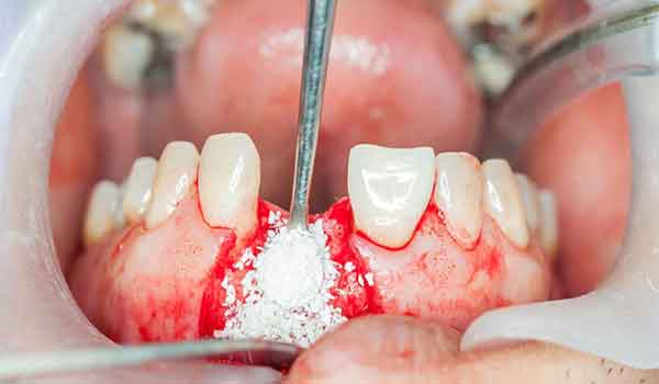 گرافت دندان چیست؟