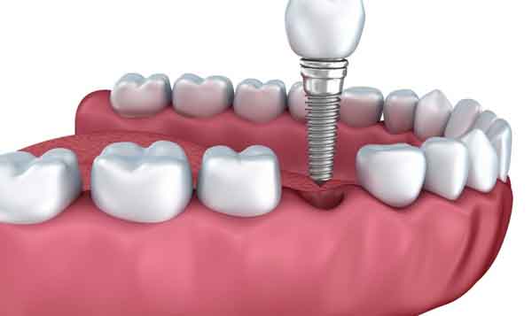بررسی وضعیت دندان‌ها برای ایمپلنت