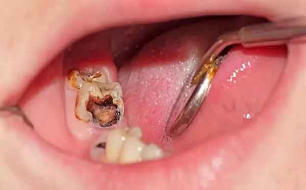 برای عفونت دندان چی بخوریم؟