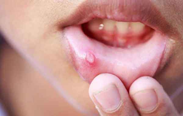 درمان خانگی موکوسل دهان