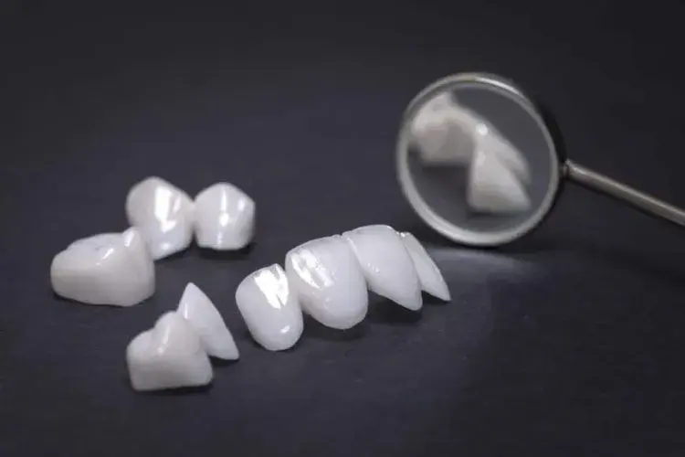 تفاوت ایمپلنت و کامپوزیت دندان